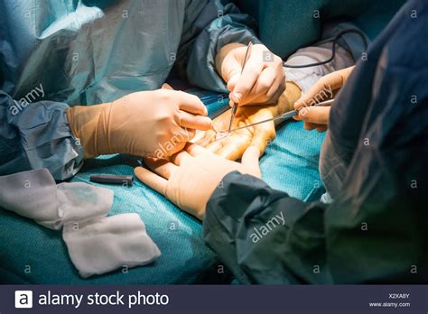 Dupuytrens Contracture Hand Surgery High Resolution Stock Photography and Images - Alamy