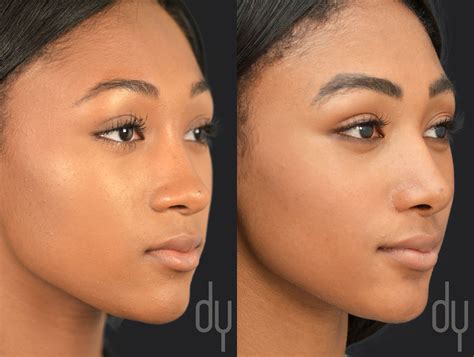 Before and After ethnic rhinoplasty with rib cartilage and diced cartilage fascia (DCF) to ...