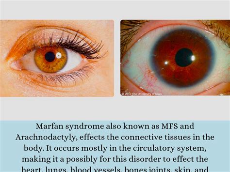 Marfan Syndrome Connective Tissue