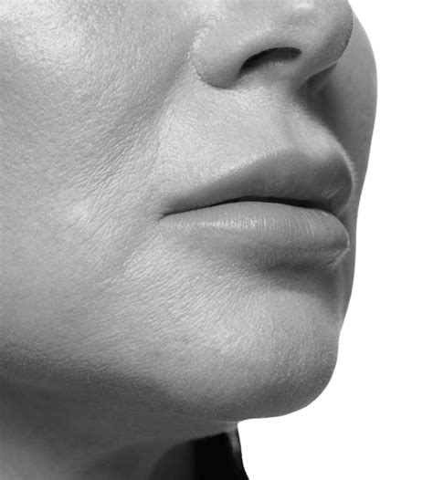 Lip Lift Sydney - Dr Bish Soliman - Soliman Plastic Surgery