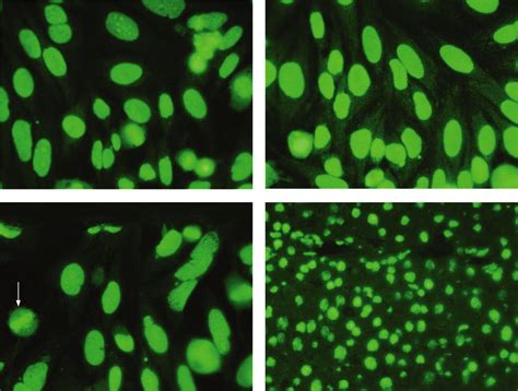 The clinical significance of antinucleolar antibodies | Journal of Clinical Pathology