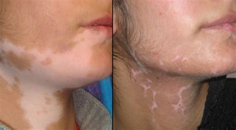 All About Vitiligo Treatments In Melbourne - biomeso