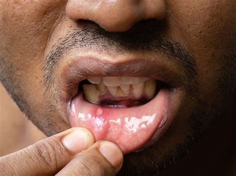 Mouth Sores: Pictures, Causes, Types, Symptoms, and Treatments