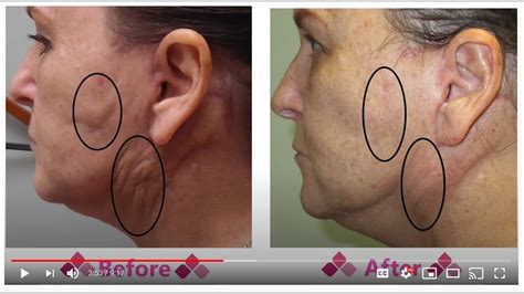 Fibrosis to Face After a Face Lift : Aspen Facelift Treatment for Lumpy Knots - YouTube