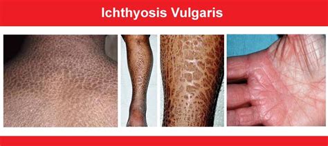 Ichthyosis Vulgaris Histology