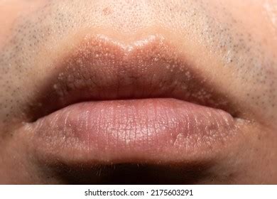 Closeup Face Women Show Small Pimple Stock Photo 1520017709 | Shutterstock