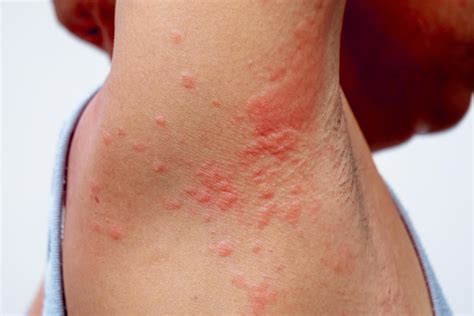 Erupción alérgica del problema de la dermatitis. problema de la piel por alergia a los ...