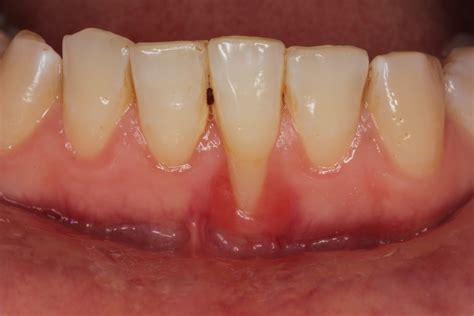 Gingivitis: Symptoms Treatment & Prevention Explained | Franklin Dental