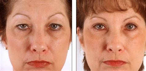 Eyelid Surgery Recovery Photos Eyelid Surgery Cost