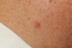 Skin Cancer Photos | ACMS - American College of Mohs Surgery