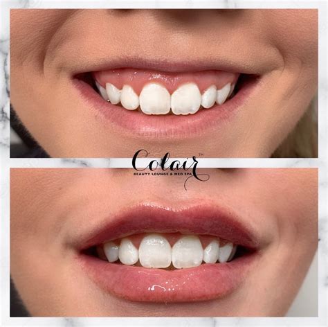 Treating Gummy Smile with Botox | Colair Beauty Lounge