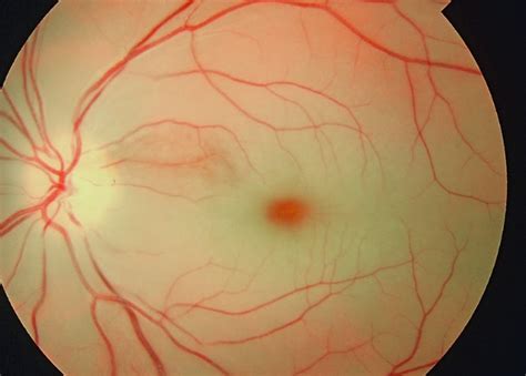 Macular Cherry Red Spot: Causes, Symptoms, and More