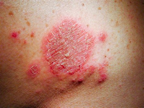 Nahaufnahme Allergischer Hautausschlag Dermatitis Ekzem Auf Der Haut | My XXX Hot Girl