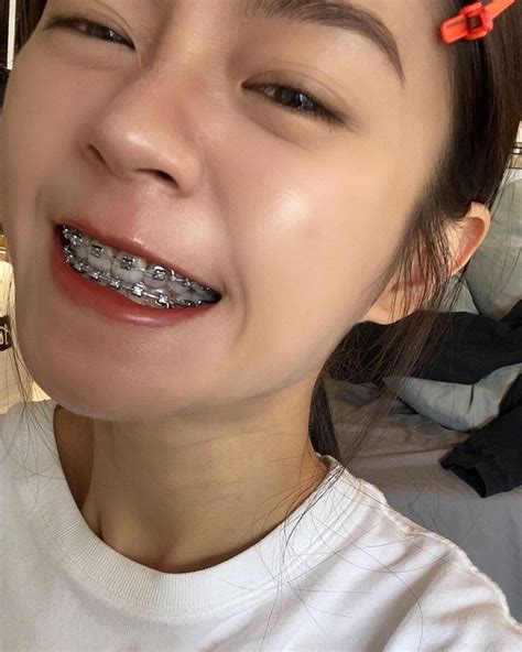 ปักพินโดย Shrood Burgos ใน Braces | สีจัดฟัน, จัดฟัน, ฟัน