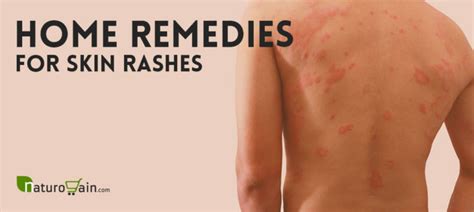 9 Home Remedies for Skin Rashes and Itching that Work [Naturally]
