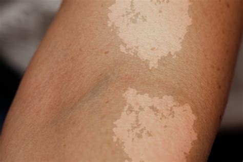 Tinea Versicolor : Overview, Causes, Symptoms, Treatment - illness.com