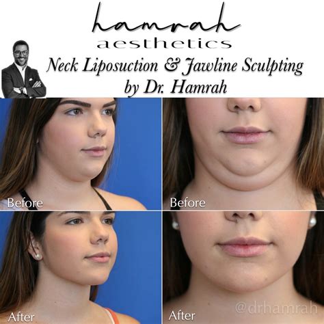 Neck and Chin Liposuction - Nova Surgicare