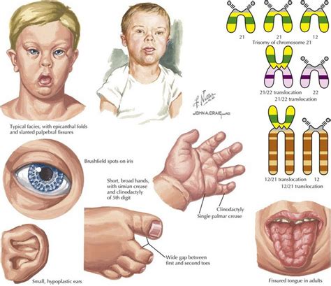 Phenotype Of Down Syndrome - Captions Hunter