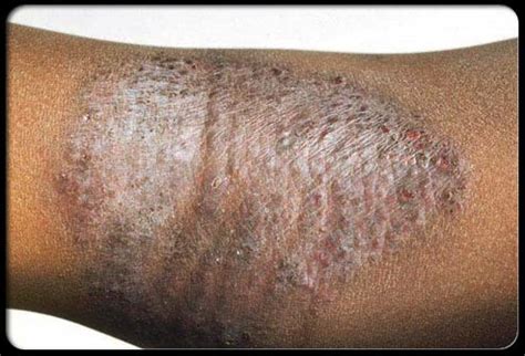 Eczema: Slideshow | Home remedies for eczema, Eczema treatment, Atopic ...