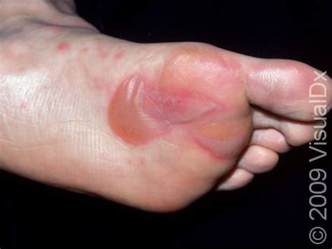 The Many Types And Causes Of Foot Blisters Blister, 44% OFF