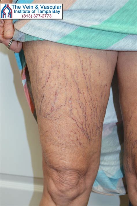 Spider Veins are a sign of a deeper vascular disease. | Spider vein treatment, Veins treatment ...