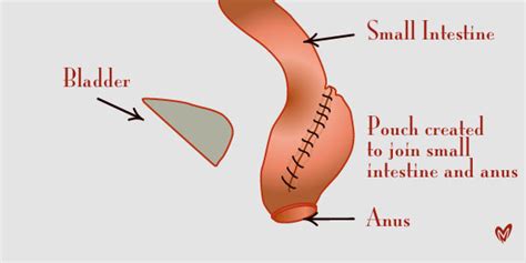 Pouchitis | Australia| PDF | PPT| Case Reports | Symptoms | Treatment