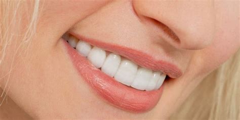 9 Types of Dental Veneers | Pros + Cons