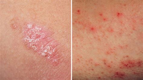 What Is The Differences Between Eczema And Psoriasis - ZOHAL