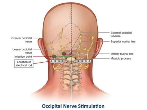 Occipital Neuralgia: Symptoms, Diagnosis, and Treatment