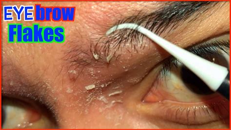 Eyebrow Flake Montage Ep3 | DANDRUFF FLAKES | SEBORRHEIC DERMATITIS | PitaFlakes - YouTube