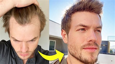 My Turkey Hair Transplant 4 Month Update | Before & After - YouTube