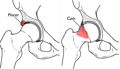 FAI FAQ's - Dr. Rice | Cam Impingement & Pincer Impingement Cincinnati