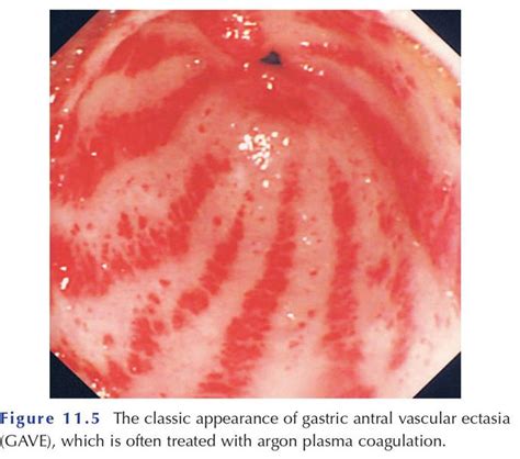 Gastric Antral vascular ecstasia - MEDizzy