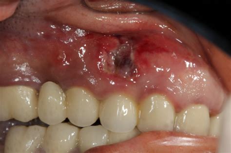 Dental Bone Grafting Complications - Dental News Network