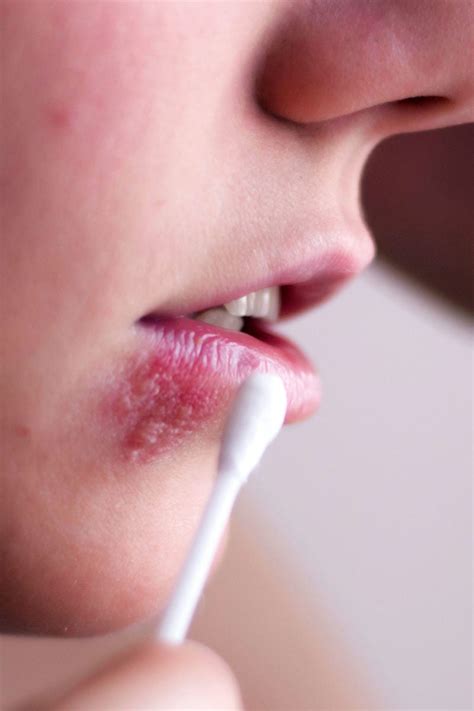 Herpes in females: Symptoms, diagnosis, and treatment