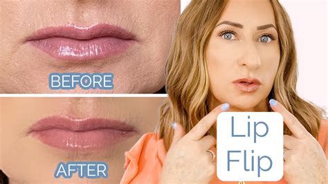 Lip Botox Before And After