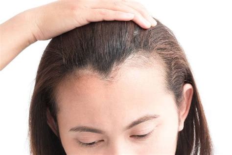 Why Is My Hairline Uneven? Causes & Treatments – DS Healthcare Group