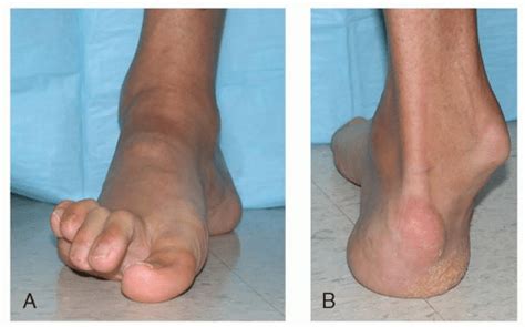 Cavovarus Deformity | Musculoskeletal Key