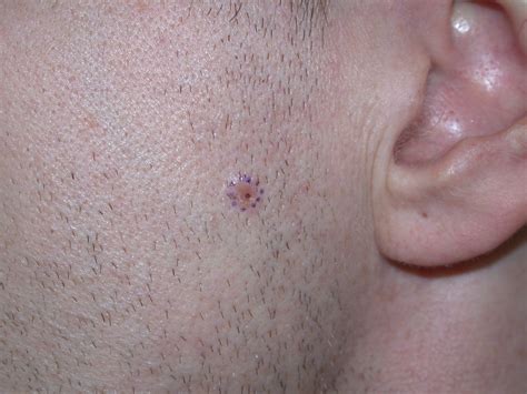 ACD A-Z of Skin - Basal cell carcinoma (BCC)