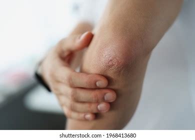 Eczema On Elbows