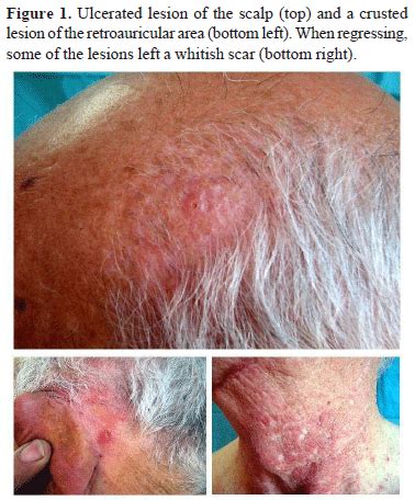 SciELO - Brasil - Scalp folliculitis with Demodex: innocent observer or ...