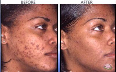 Vitamin e acne scars before and after