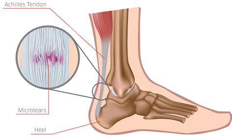 Achilles Tendonitis Specialist - Downtown and Midtown New York, NY ...