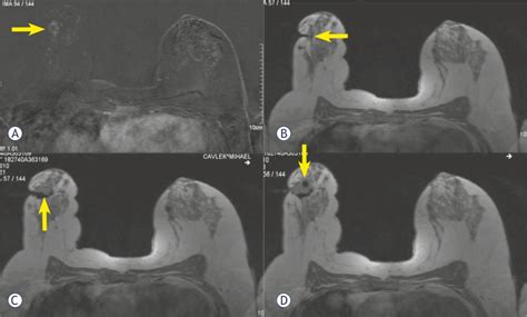 MRI-guided biopsy using axial, contrast-enhanced FLASH 3D T1W images ...