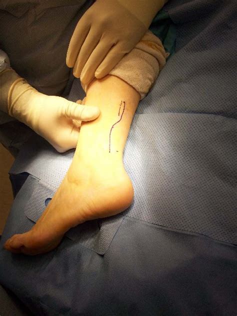 Ganglion Cyst | The Foot and Ankle Online Journal