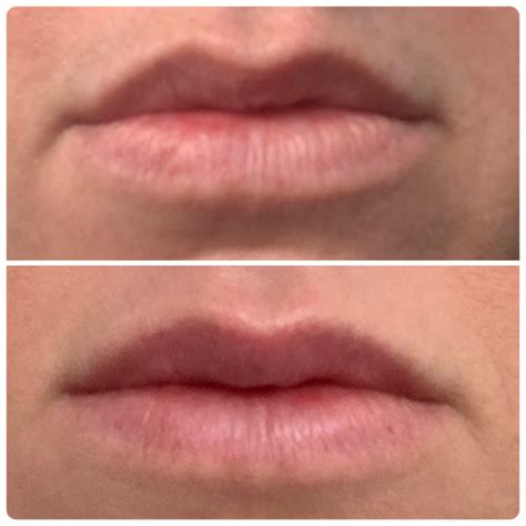 Lip Flip with Botox Results - dana carolyn