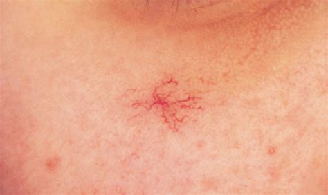 Spider angioma causes, symptoms, diagnosis & spider angioma treatment