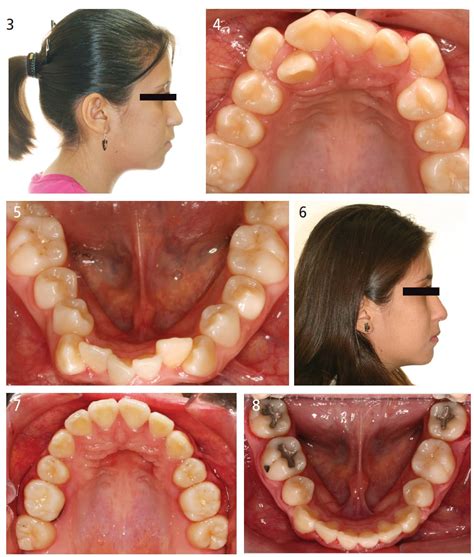 how braces work after extraction - Denice Nolan