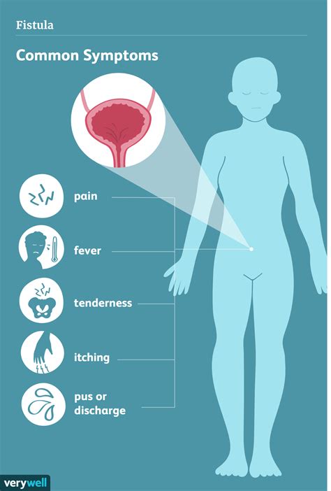 Symptoms and Treatment for Fistulas