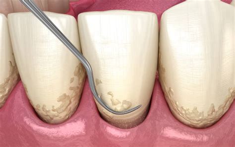 Periodontal scaling and root planing | Fine Quality Dental